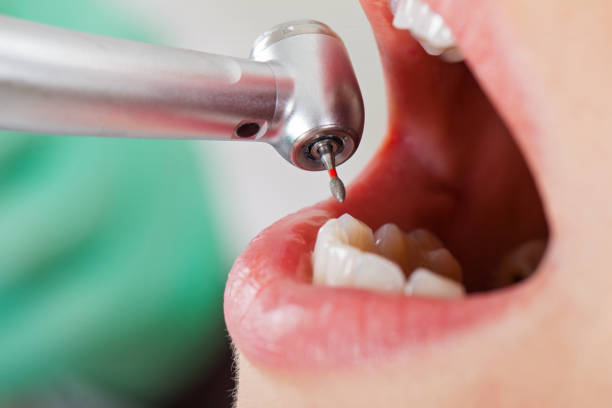 Best Emergency Root Canal Treatment in Manila, AR